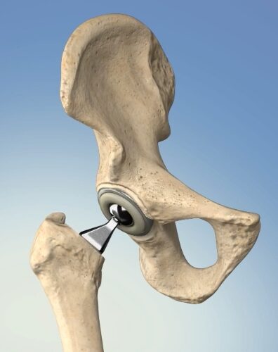 Hip Replacement