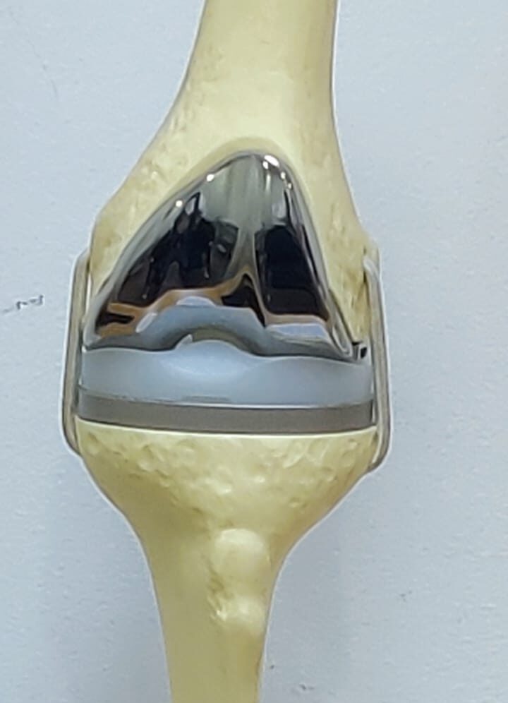 Knee Replacement