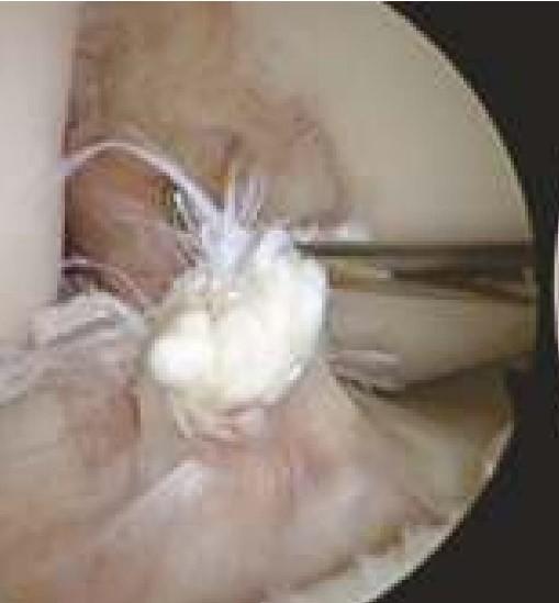 ACL surgery in bangalore