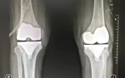 Can You Undergo Both Knee Joint Replacement Surgeries at a Time?