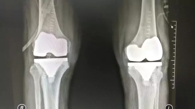 Can You Undergo Both Knee Joint Replacement Surgeries at a Time?