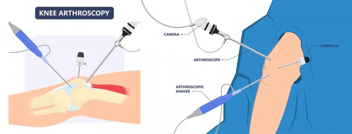 Knee Arthroscopy treatment