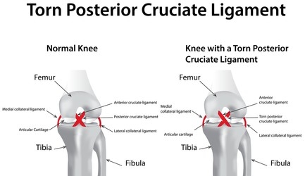 Torn Posterior Cruciate Ligament