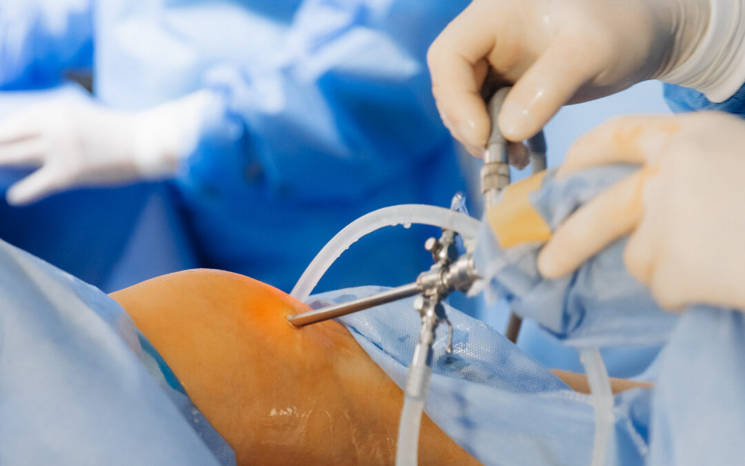 Knee Arthritis: Do You Really Need Surgery? Here’s the Truth